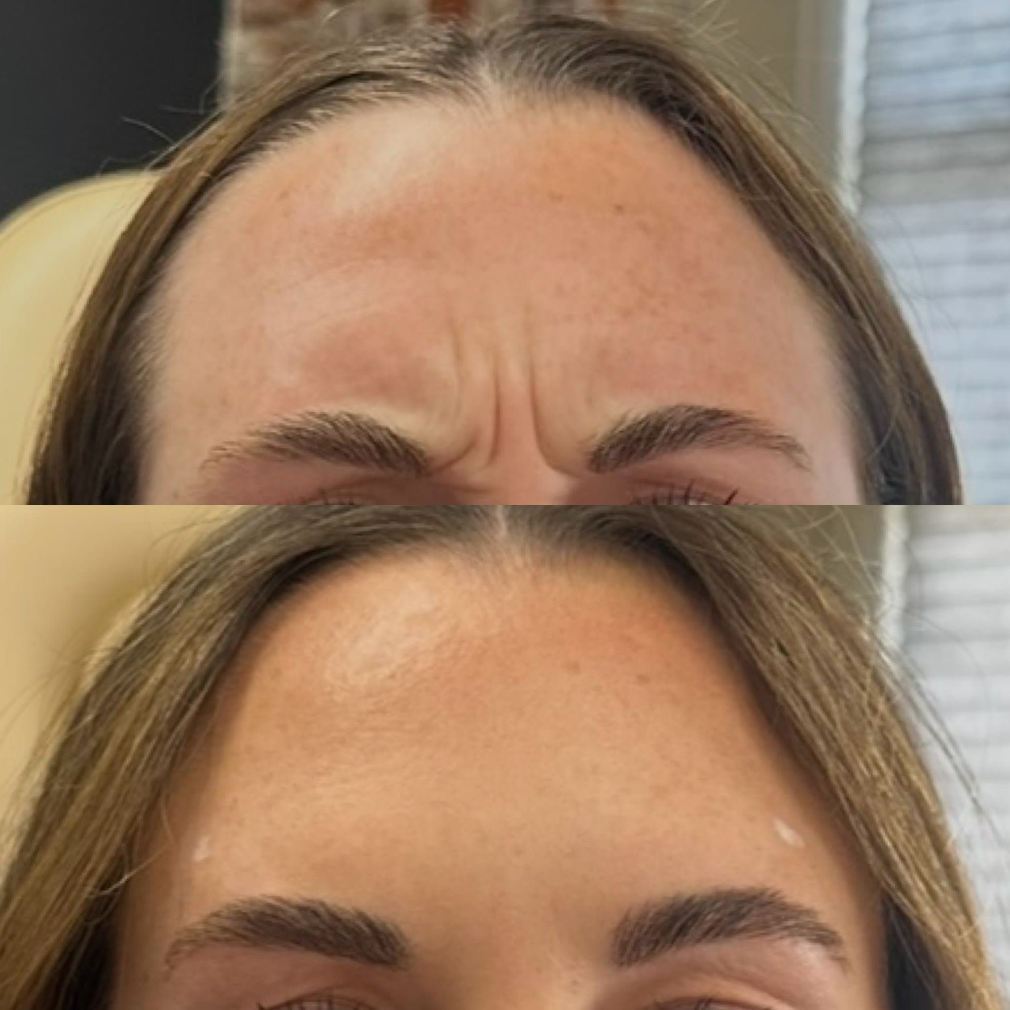 Before and after treatment result at Ren Aesthetics & Wellness