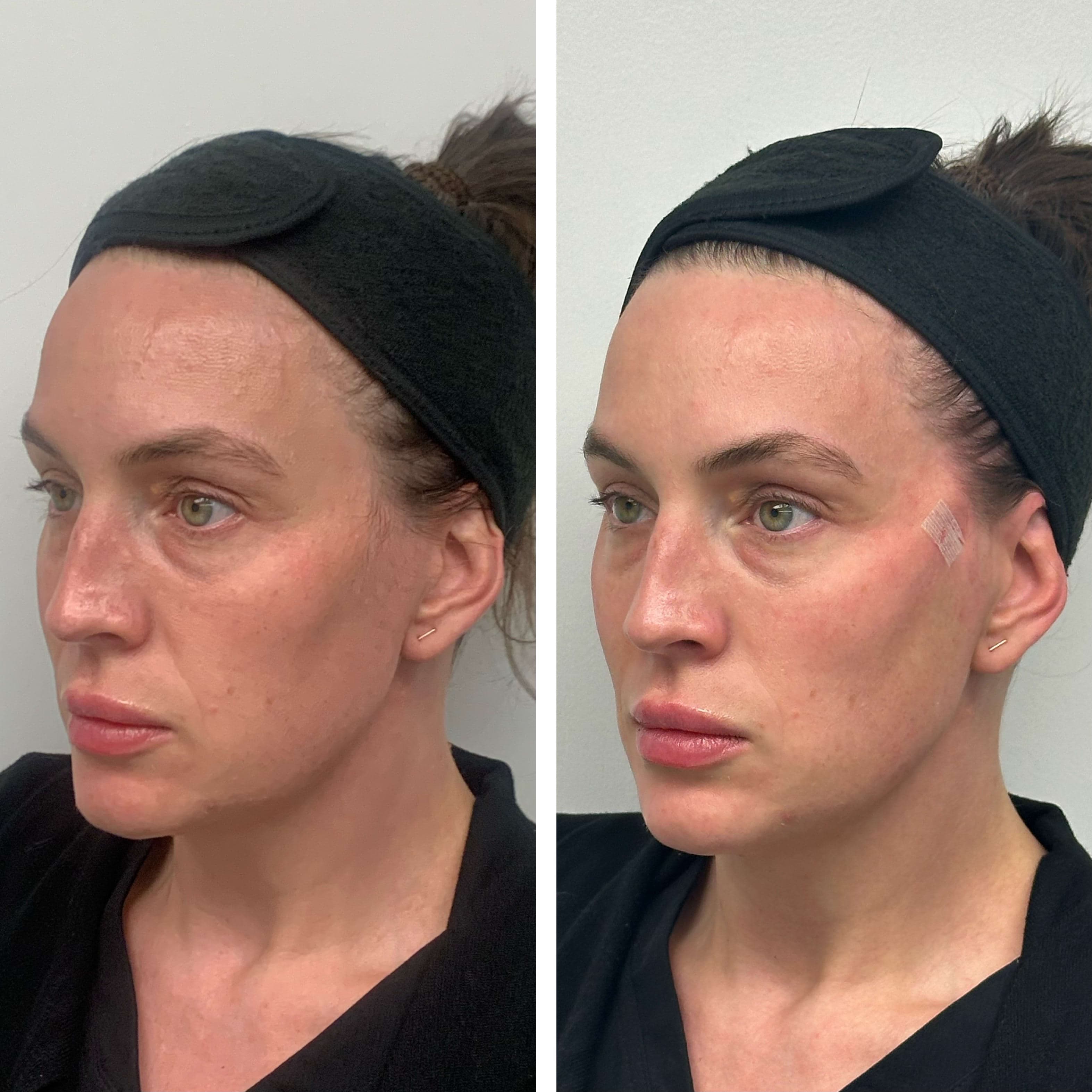 Before and after treatment result at Ren Aesthetics & Wellness