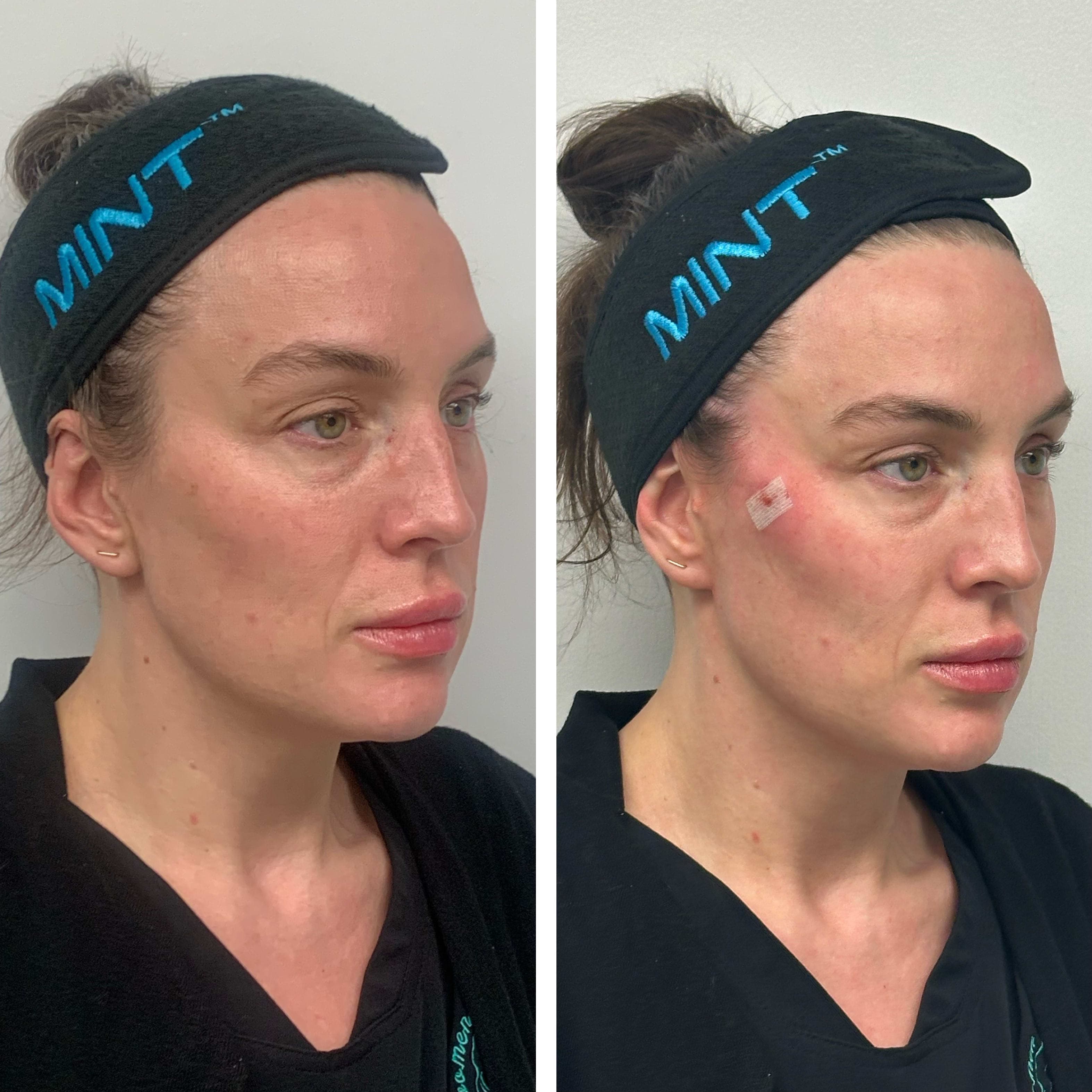 Before and after treatment result at Ren Aesthetics & Wellness