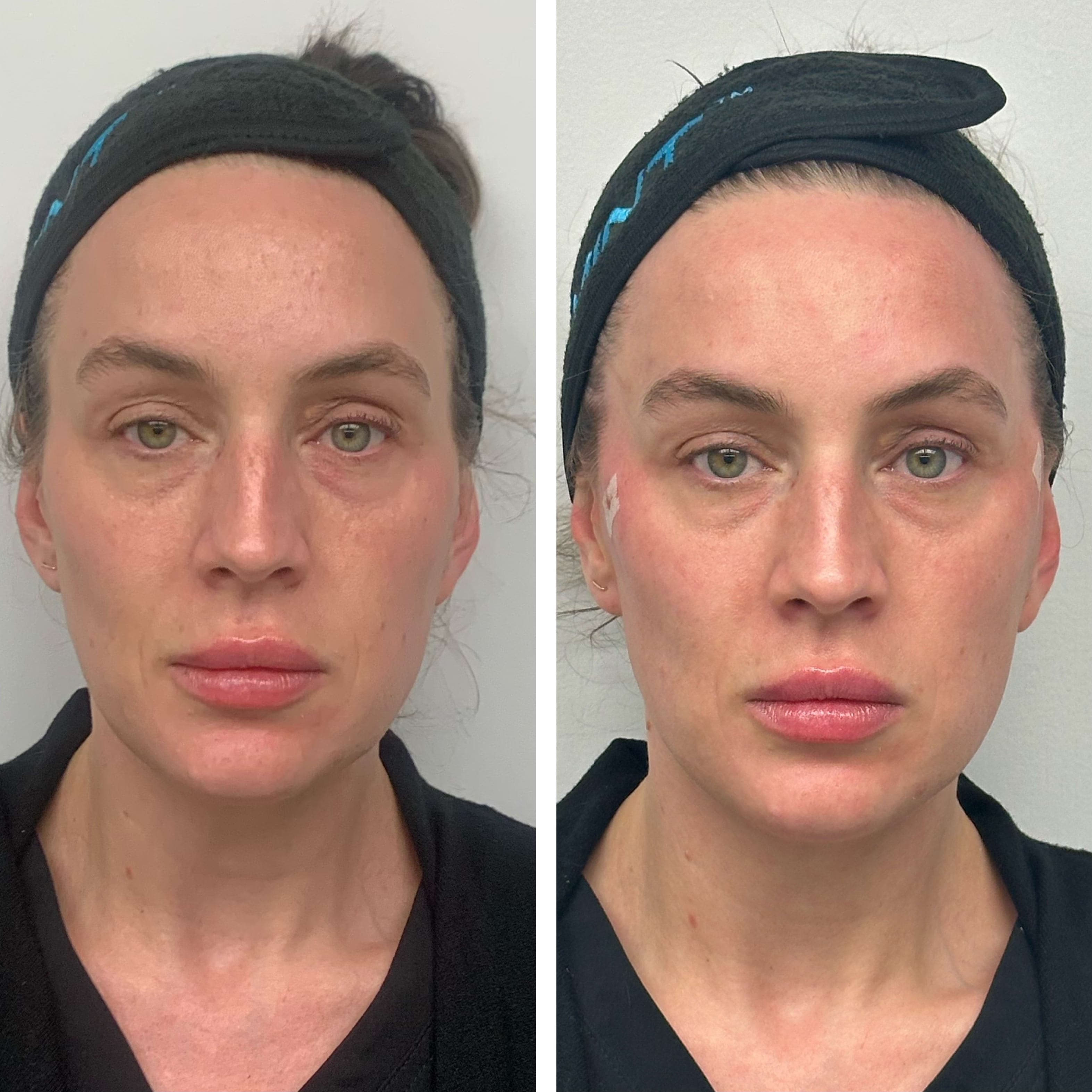 Before and after treatment result at Ren Aesthetics & Wellness