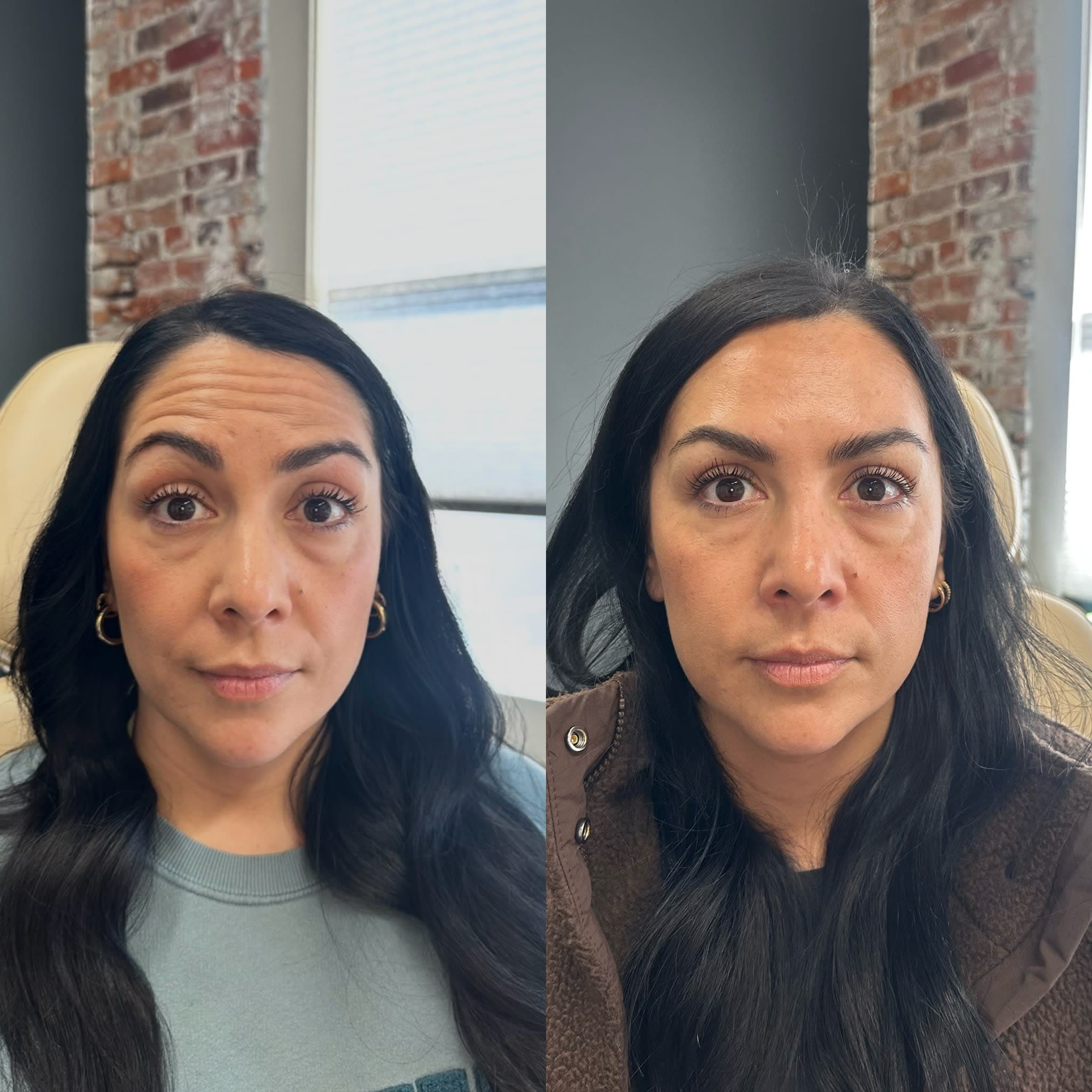 Before and after treatment result at Ren Aesthetics & Wellness