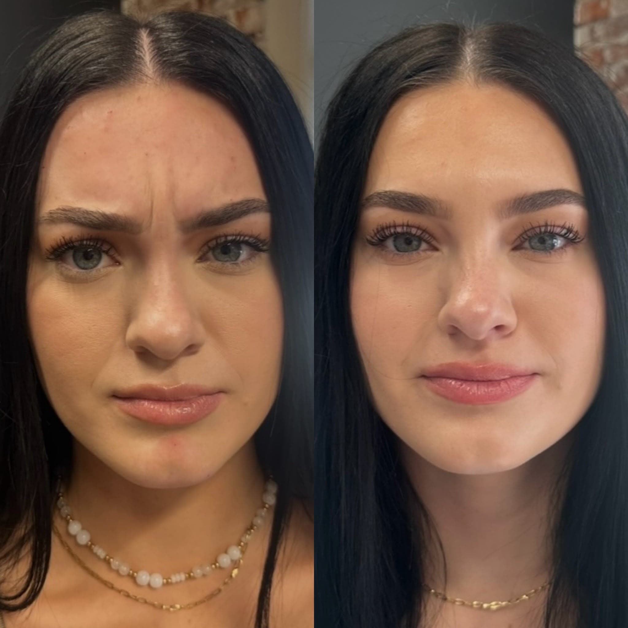 Before and after treatment result at Ren Aesthetics & Wellness