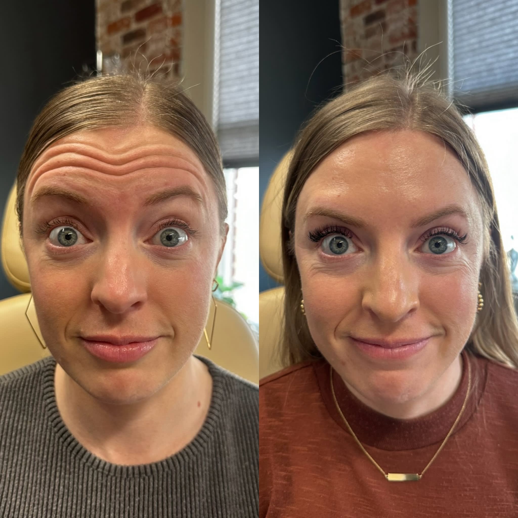 Before and after treatment result at Ren Aesthetics & Wellness