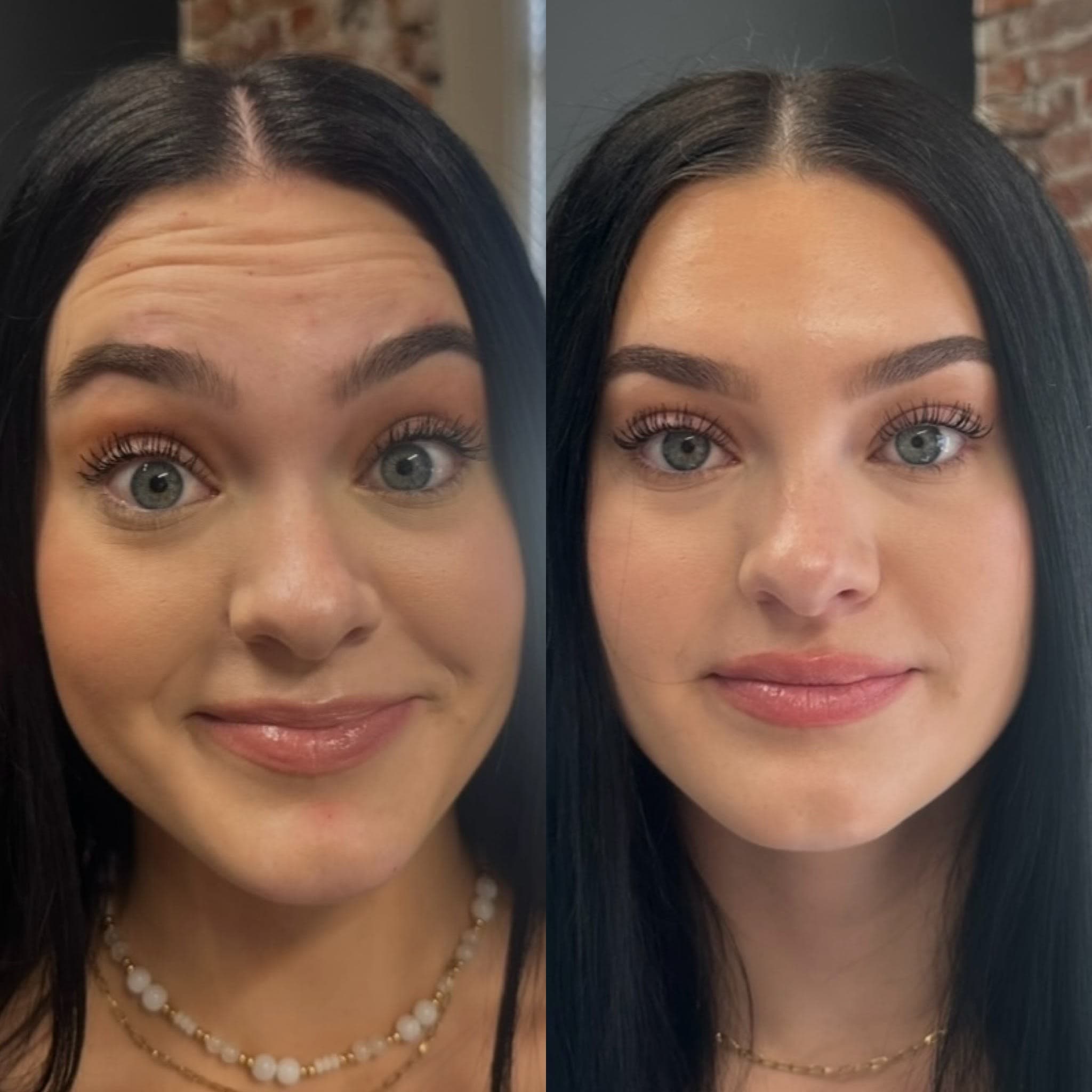 Before and after treatment result at Ren Aesthetics & Wellness