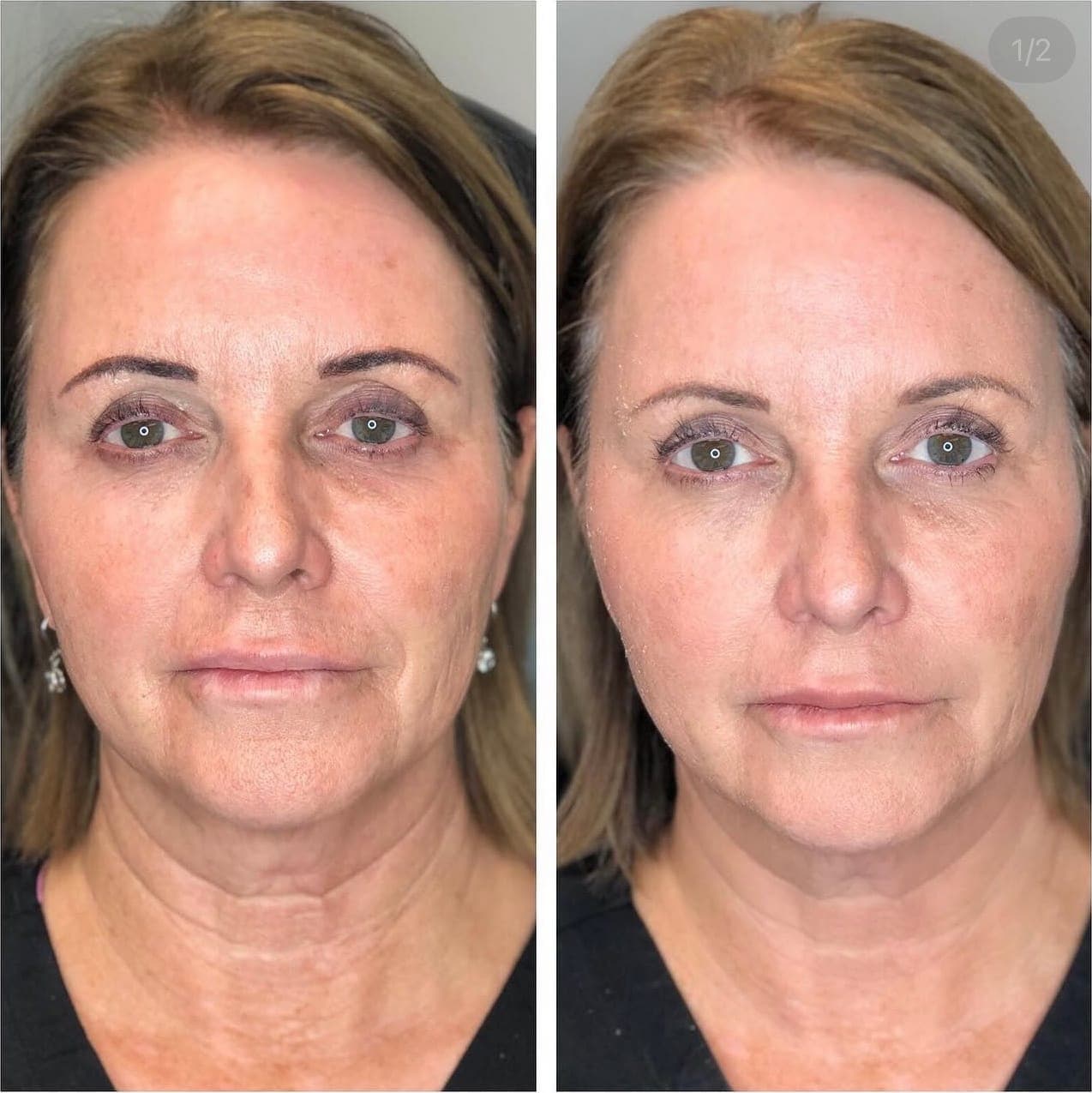 Before and after treatment result at Ren Aesthetics & Wellness