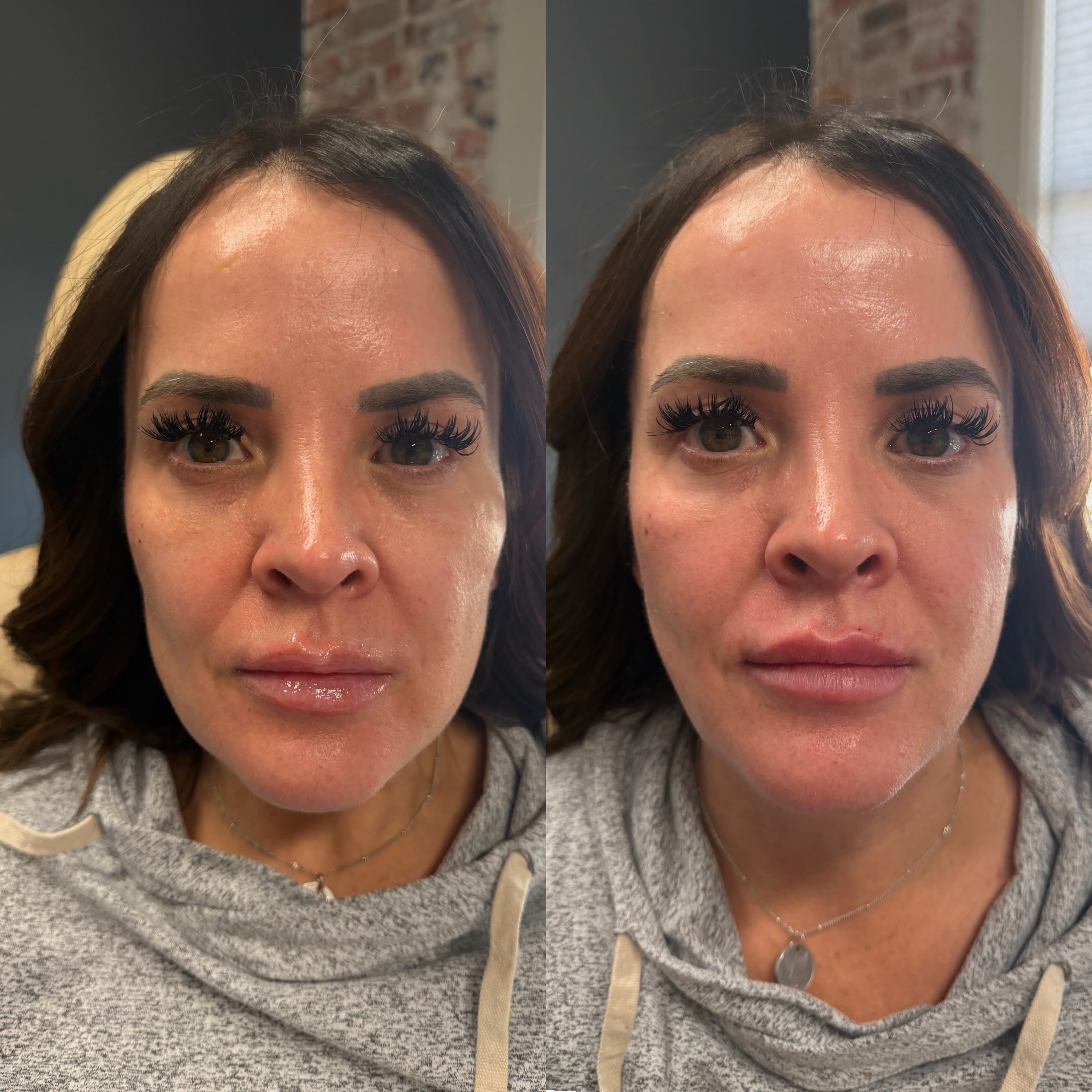Before and after treatment result at Ren Aesthetics & Wellness