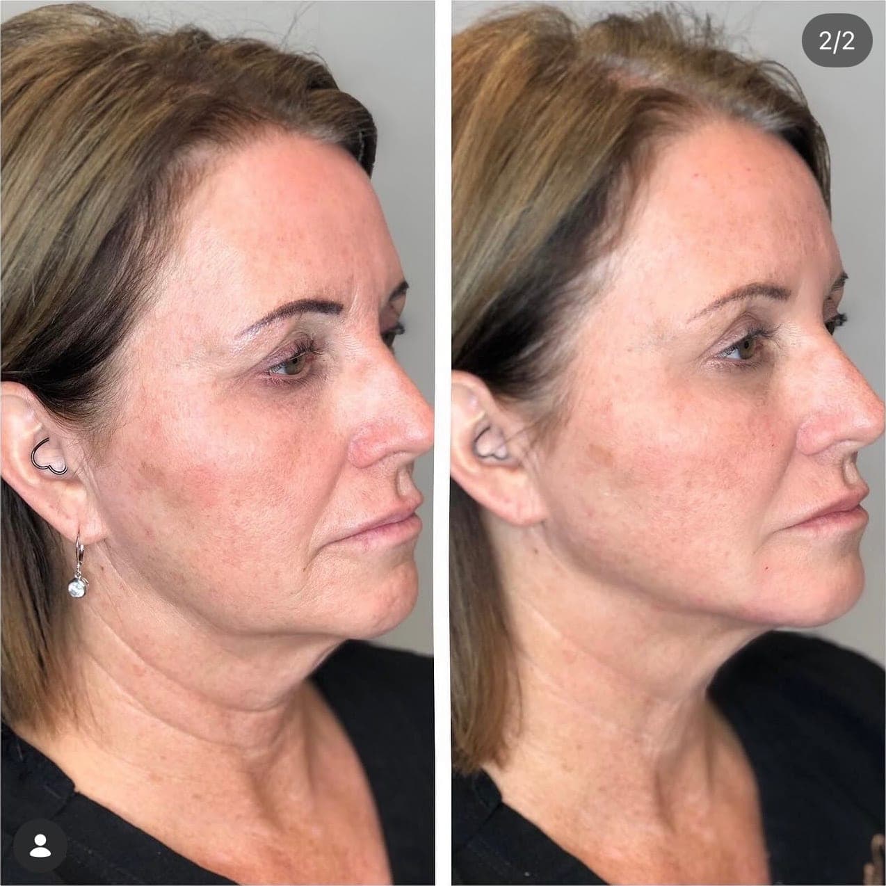 Before and after treatment result at Ren Aesthetics & Wellness