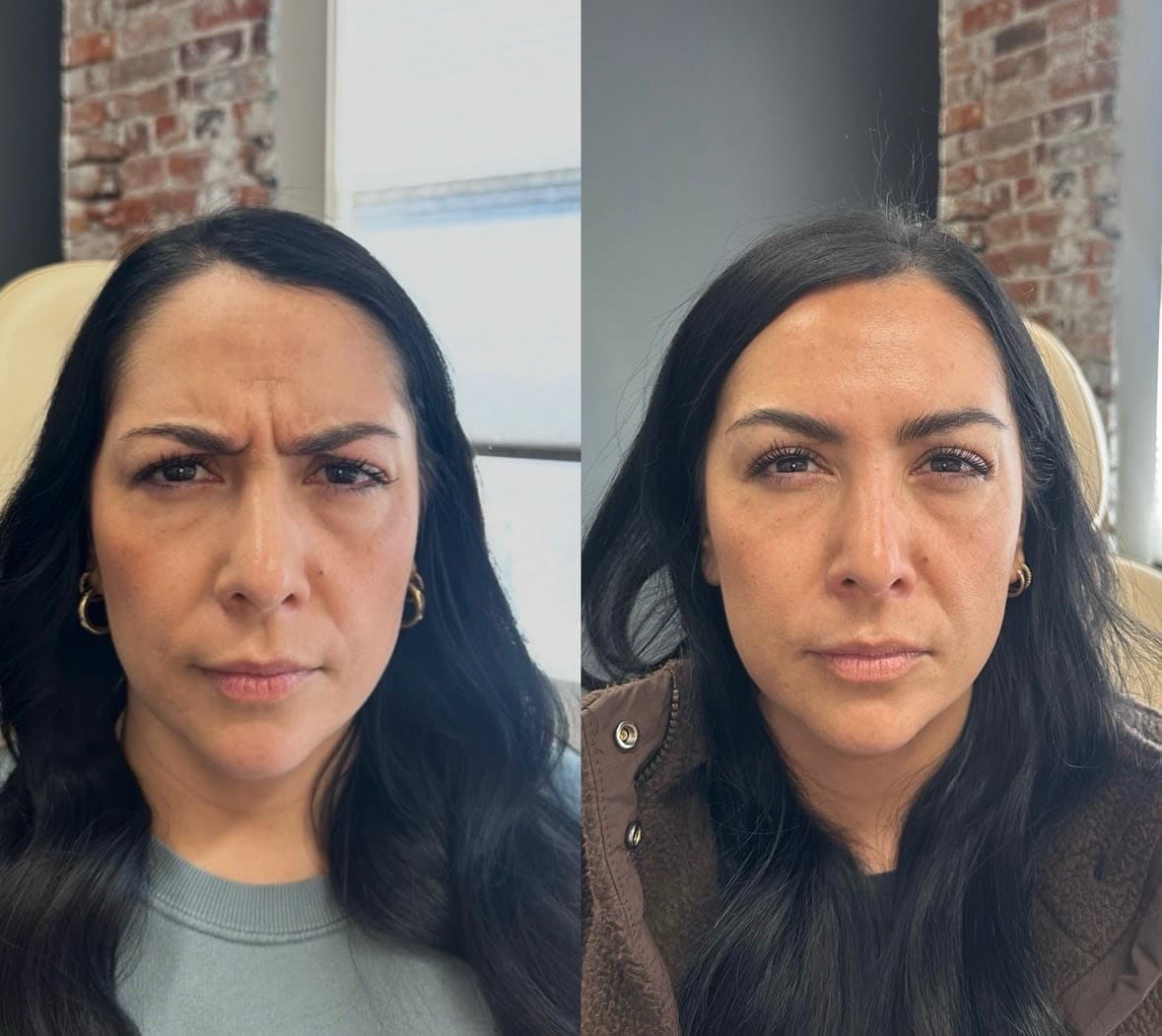 Before and after treatment result at Ren Aesthetics & Wellness