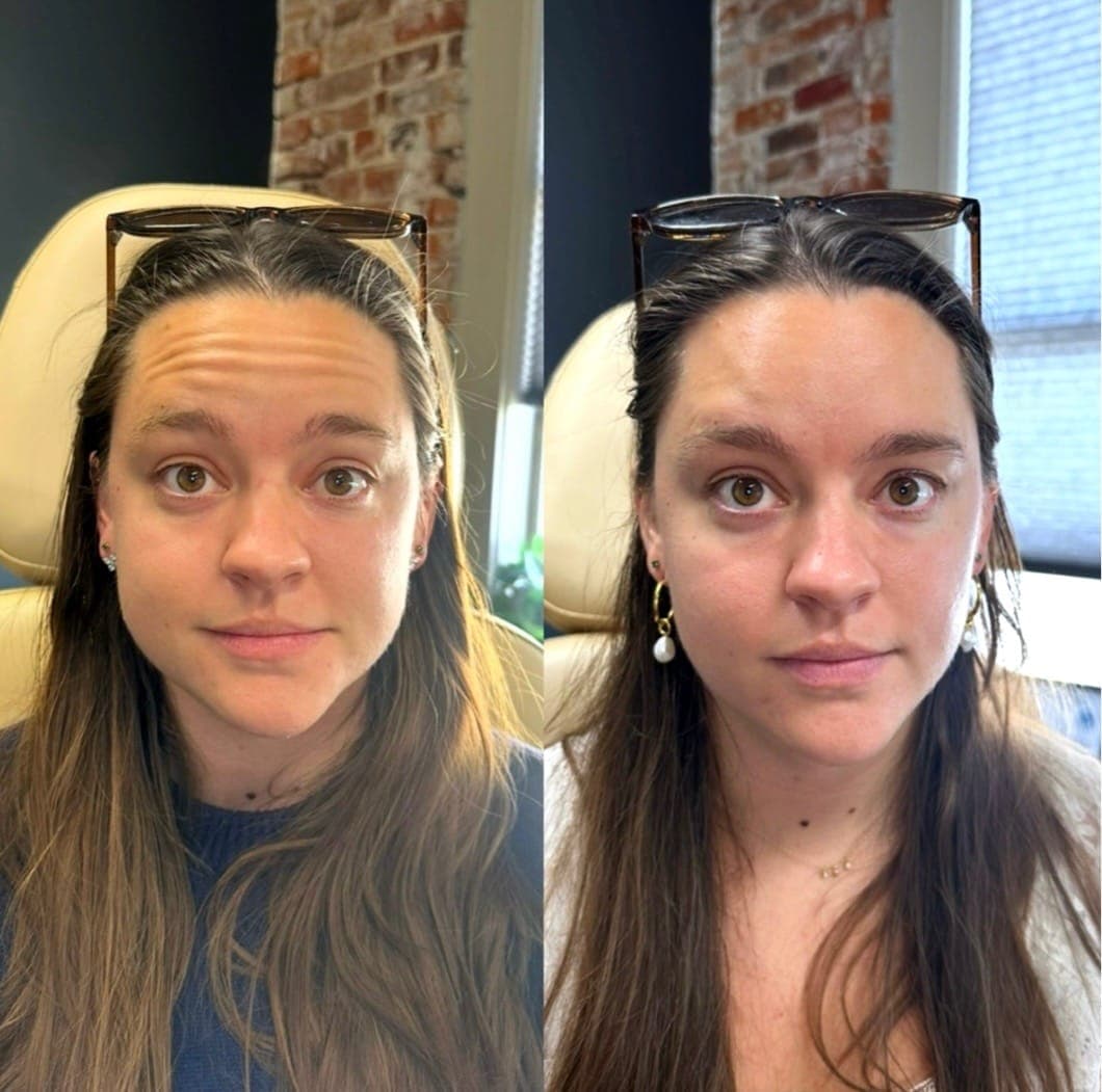 Before and after treatment result at Ren Aesthetics & Wellness