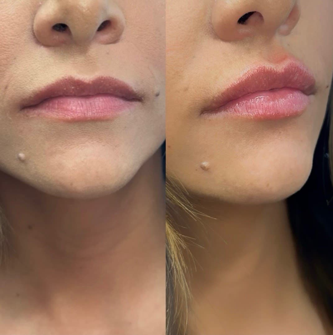 Before and after treatment result at Ren Aesthetics & Wellness