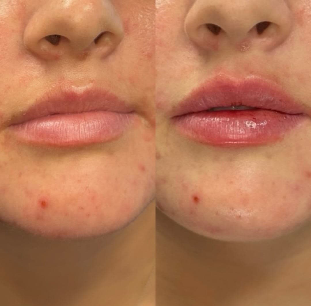 Before and after treatment result at Ren Aesthetics & Wellness