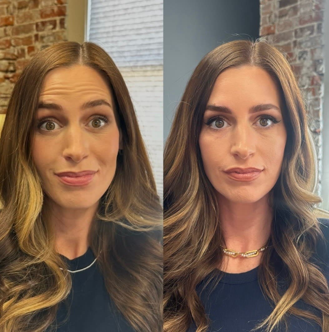 Before and after treatment result at Ren Aesthetics & Wellness