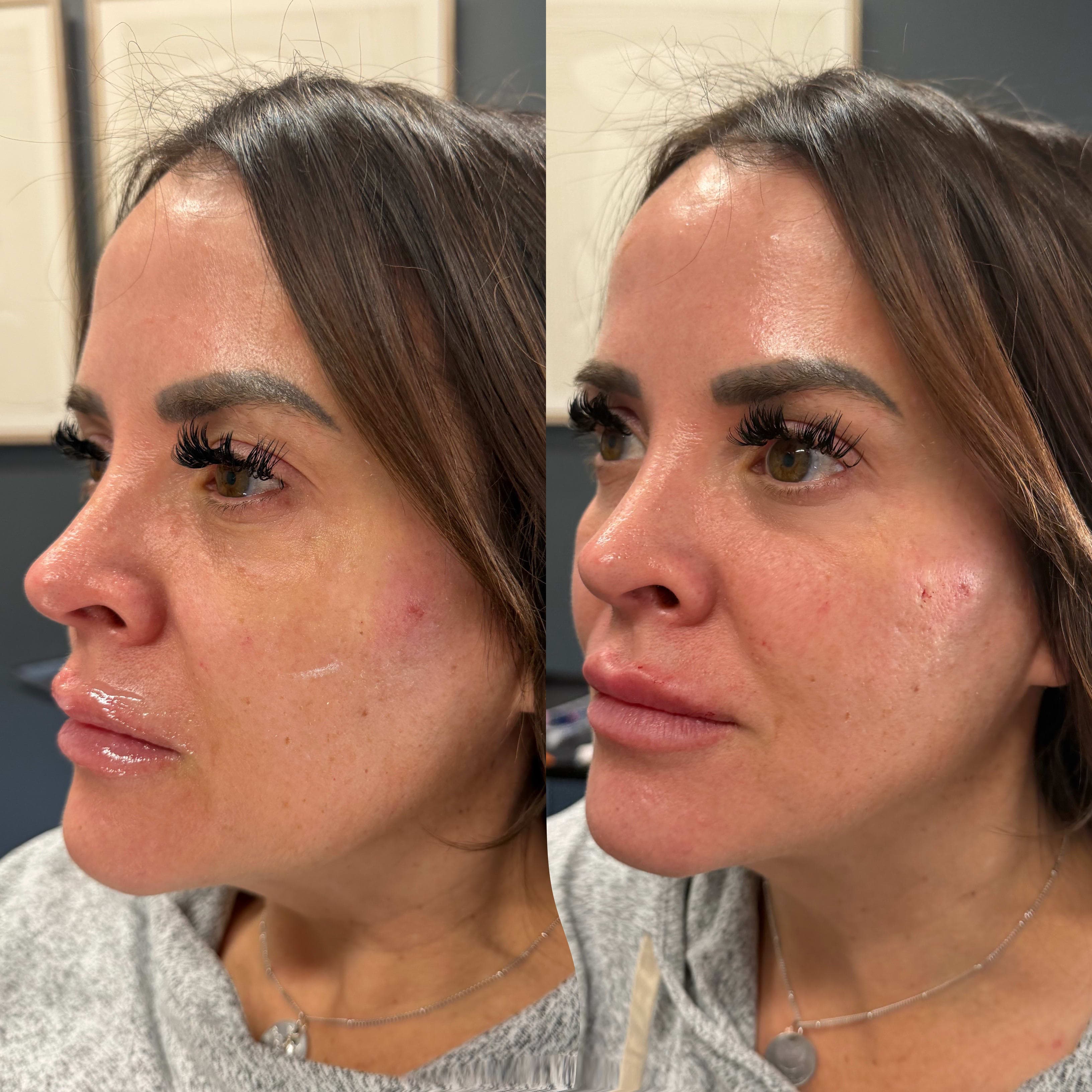 Before and after treatment result at Ren Aesthetics & Wellness