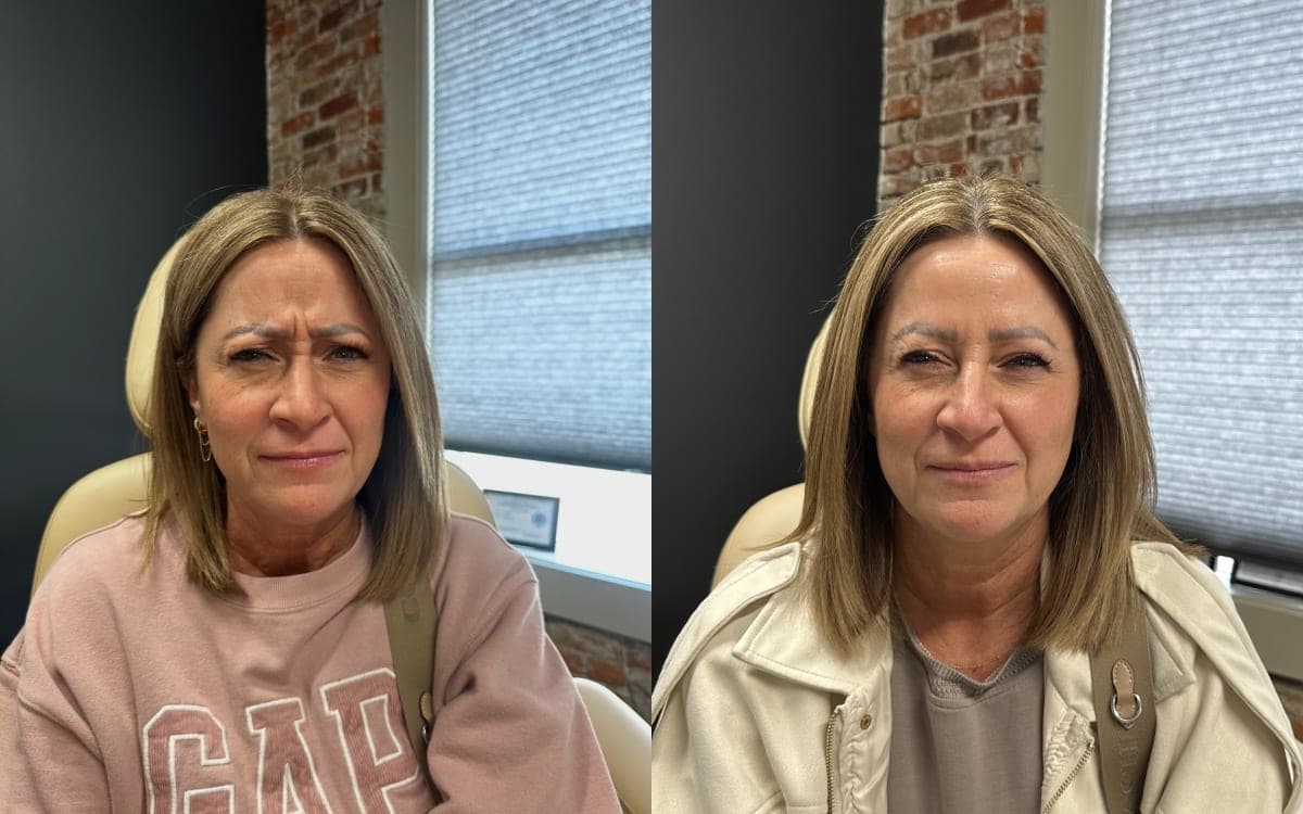 Before and after treatment result at Ren Aesthetics & Wellness