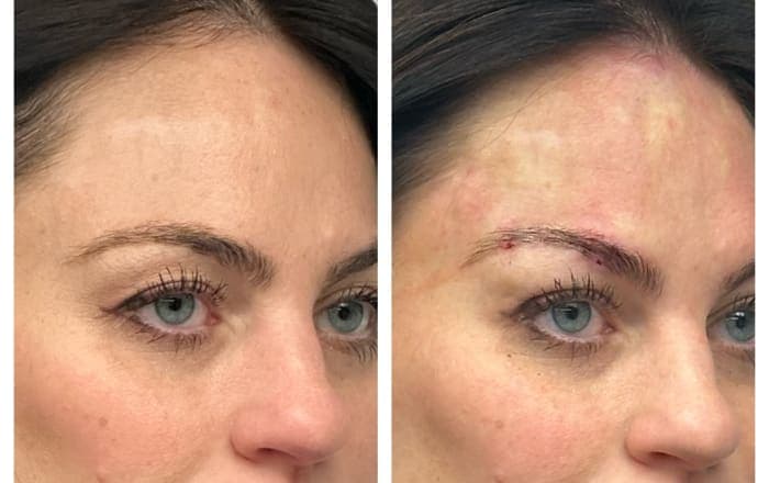 Before and after treatment result at Ren Aesthetics & Wellness