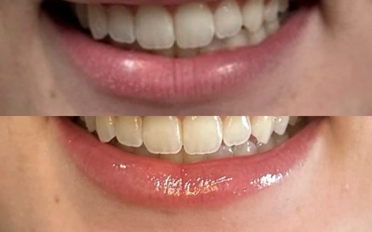 Before and after treatment result at Ren Aesthetics & Wellness