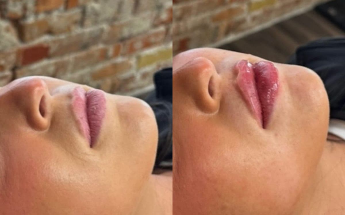 Before and after treatment result at Ren Aesthetics & Wellness